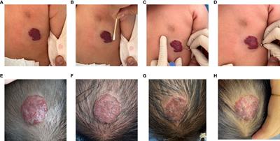 Low-dose sclerotherapy with lauromacrogol in the treatment of infantile hemangiomas: A retrospective analysis of 368 cases